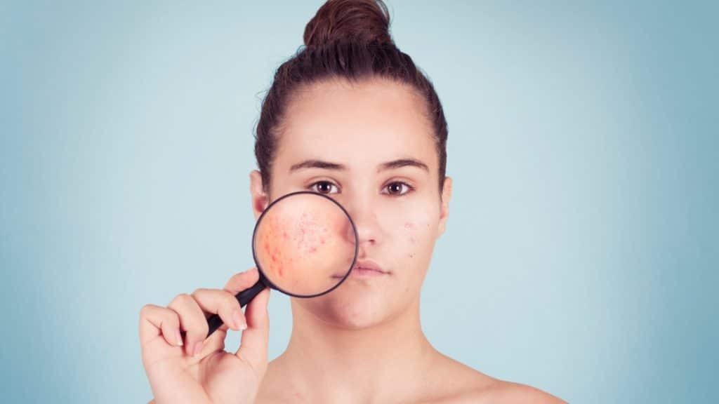5 Ways To Prevent Acne